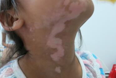 Why vitiligo relapses