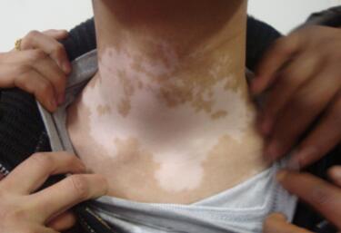 vitiligo diagnosis