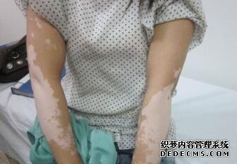 vitiligo damages