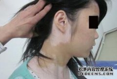 How to Treat Vitiligo on Face