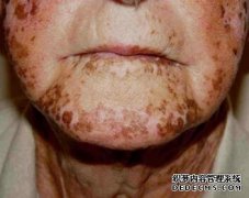 What Should Old Vitiligo Patients Do