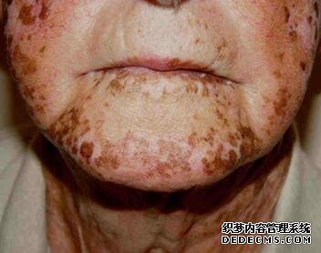 old vitiligo patients