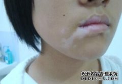 What Are the Best Therapy for Vitiligo