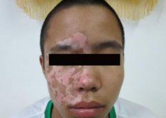 How to Diagnose Vitiligo