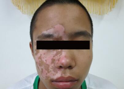 vitiligo treatment 