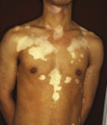 Why Vitiligo Present Symmetrical Distributi