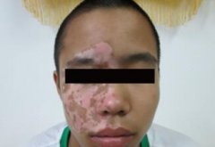 How to Nurse Vitiligo Patients