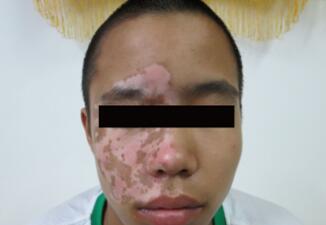 vitiligo treatment 