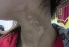 The Symptoms of Unusual Type Vitiligo