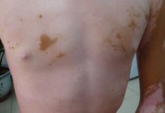 Vitiligo Symptoms for Patients