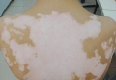 Vitiligo Health Care for Patients