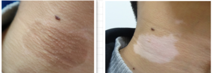 vitiligo treatment experience for one Chinese patient 