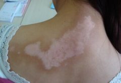 The Bad Damages to Women Vitiligo Patients