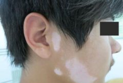 What Are the Examinations for Vitiligo Pati