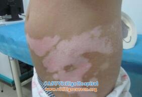 vitiligo treatment 