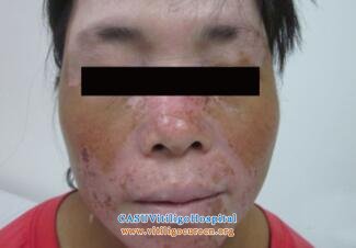 women vitiligo patients