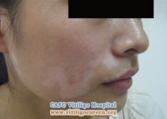 How to Treat Spreading Vitiligo