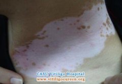 Can Vitiligo Patients Eat Carrot