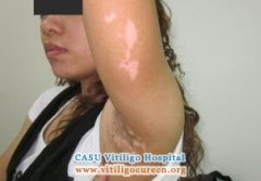 How to Adjust Vitiligo Patients’ Mentalit