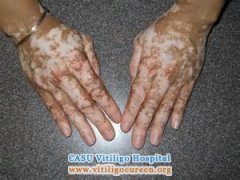 Prevent Vitiligo Relapsing