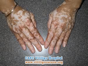 prevent vitiligo relapsing