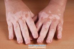 Some Questions for Vitiligo Patients