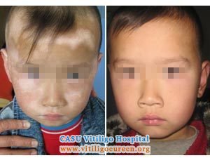 vitiligo difference between the children and adults.