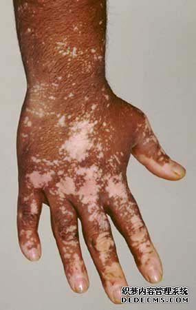 vitiligo treatment