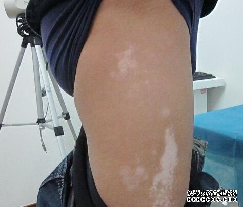 vitiligo prevention 