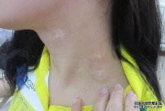 Vitiligo Patients Should not Stay Up Too La