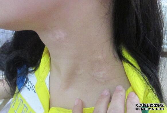 vitiligo daily care 