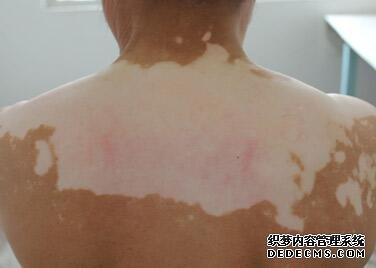 vitiligo damages