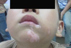 Vitiligo Causes: The Reasons to Arouse Chil