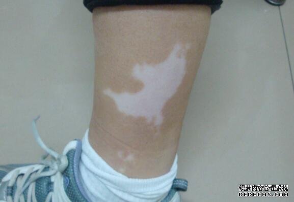 vitiligo causes