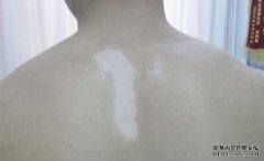 How to Treat Vitiligo in The Initial Stage