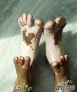 Treat Vitiligo on Feet