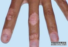 How to Treat Vitiligo on Hands