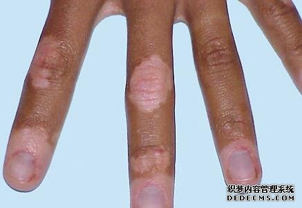 vitiligo treatment on hands