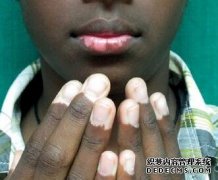 How to Care Vitiligo Patients’Skin