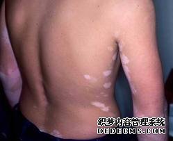 vitiligo treatment