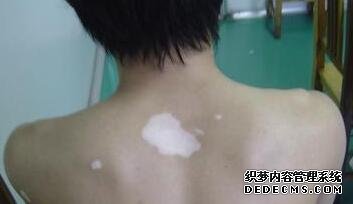 vitiligo treatment