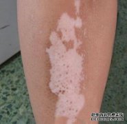 The Common Positions of Vitiligo