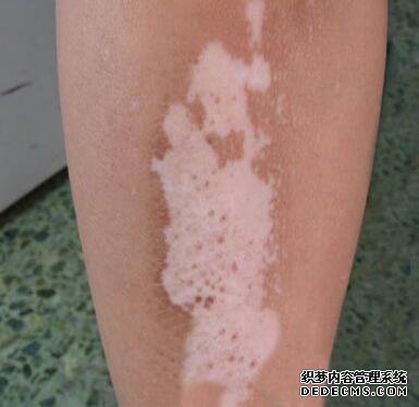 The common positions of vitiligo