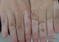 What are The Common Symptoms of Vitiligo