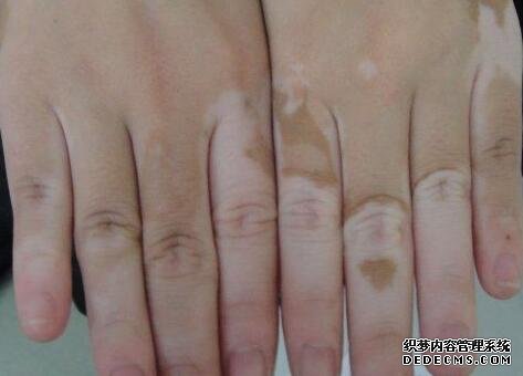 vitiligo symptoms