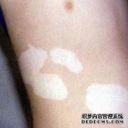 The Vitiligo Have a Great Harm