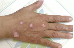 Early Symptoms For Vitiligo