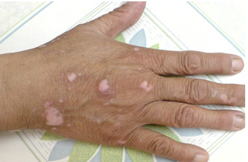 Early symptoms for vitiligo