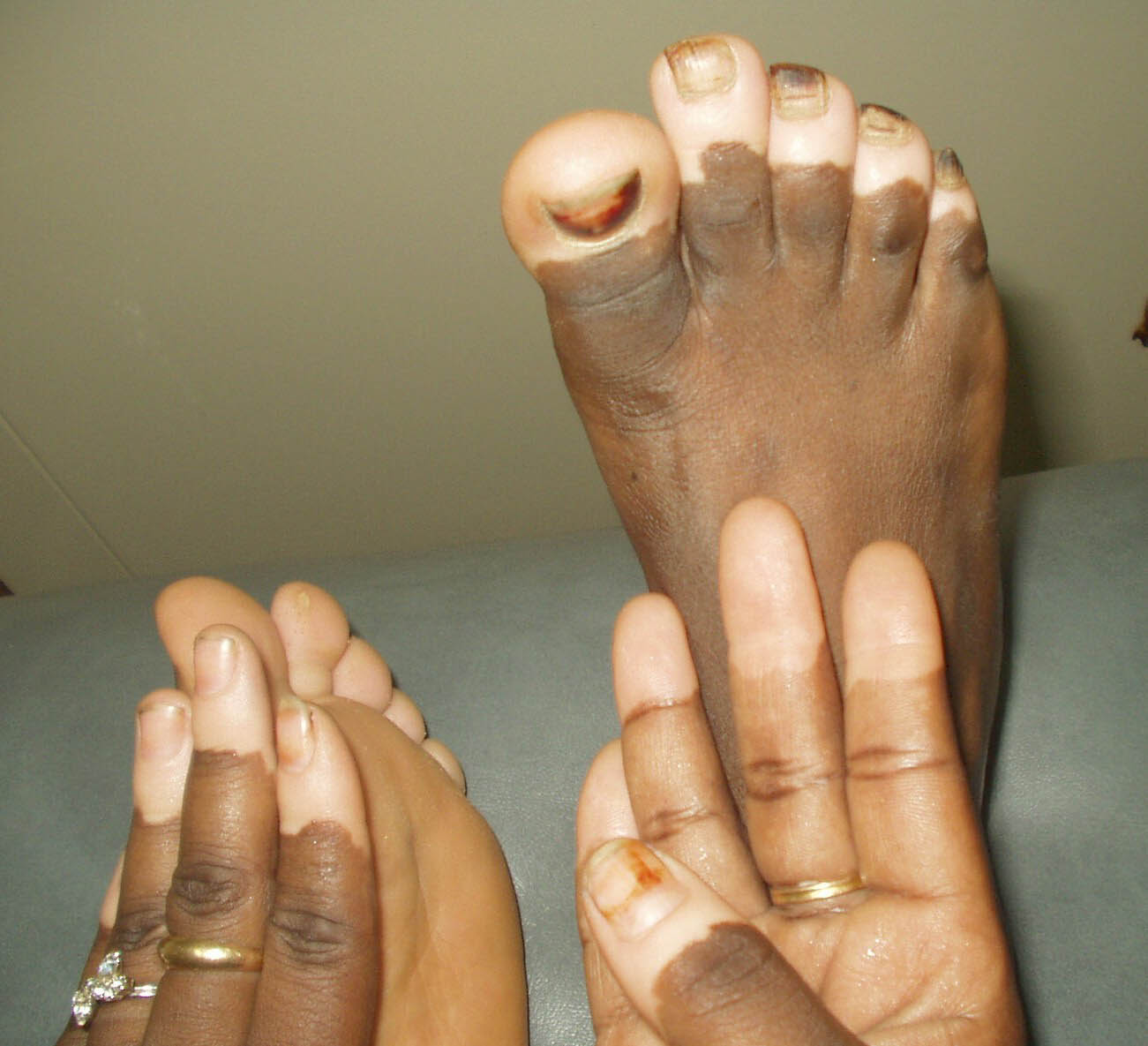 How to treat acra type vitiligo