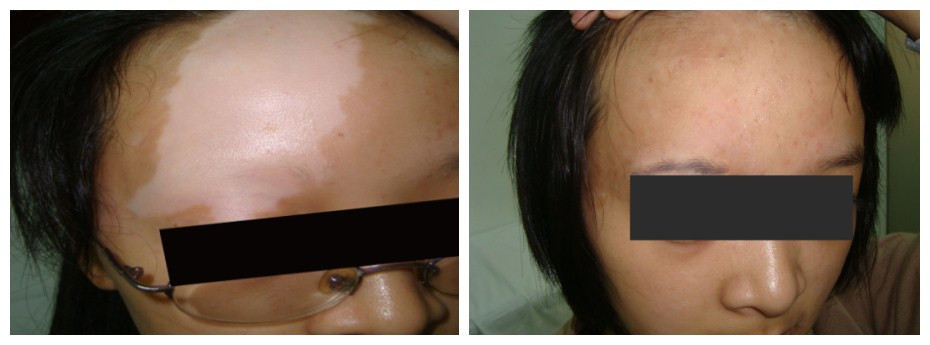 Gastric problem related to vitiligo